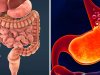 आंतों से जुड़ी गंभीर बीमारी है
