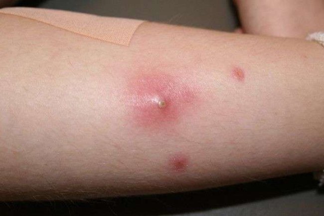 बालतोड़ के घरेलू नुस्खे