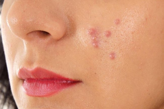 फोड़े-फुंसी के घरेलु उपचार